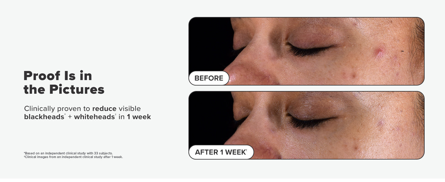 Paula's Choice SKIN PERFECTING 2% BHA Liquid Salicylic Acid Exfoliant-Facial Exfoliant for Blackheads, Enlarged Pores, Wrinkles & Fine Lines 24hrsmart